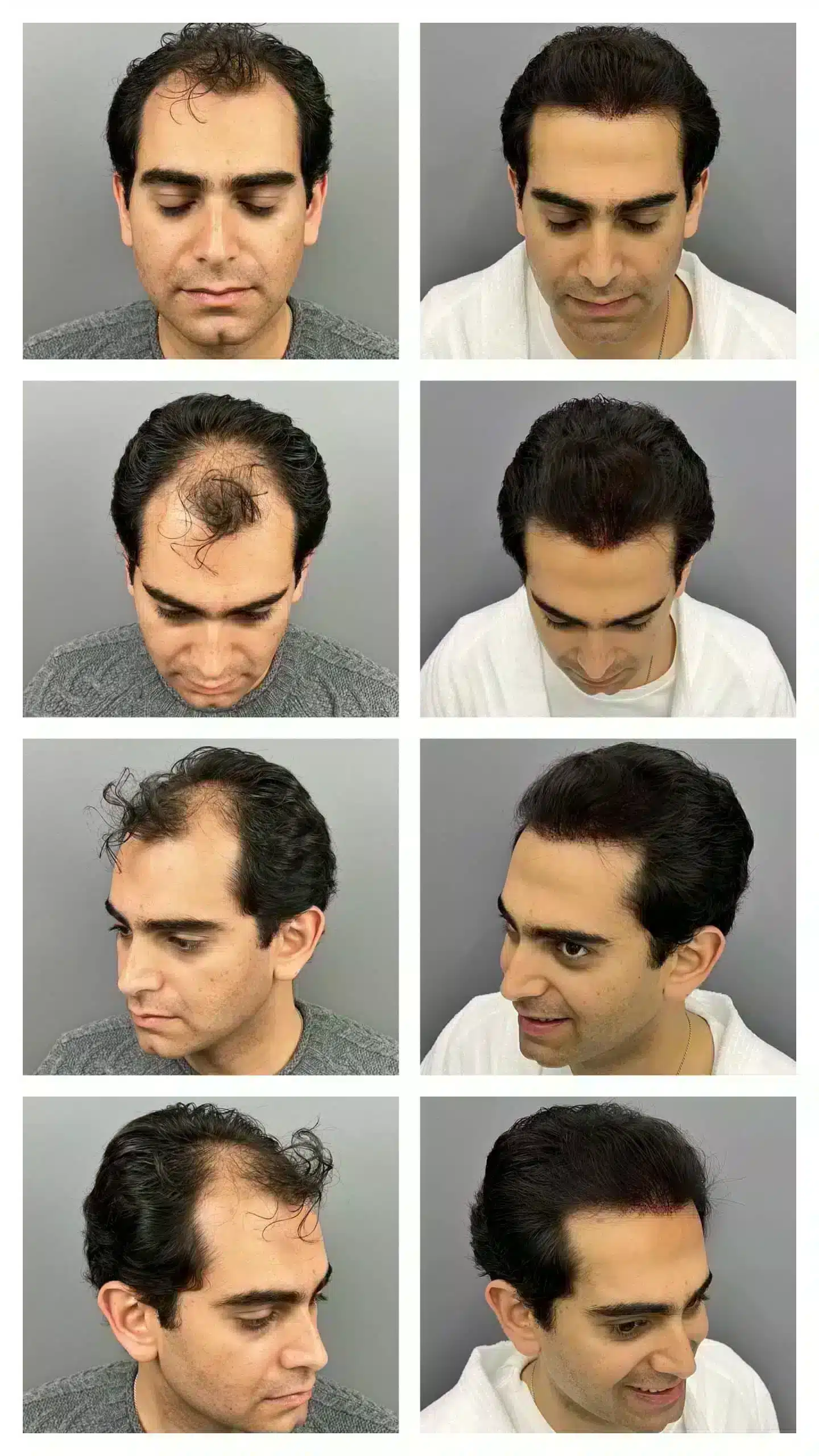Before:After HT Tsilosani 2